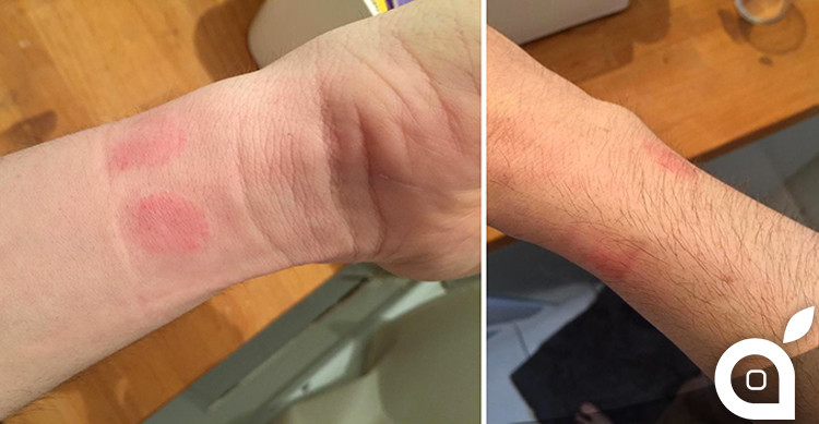 Skin irritation from Apple Watch